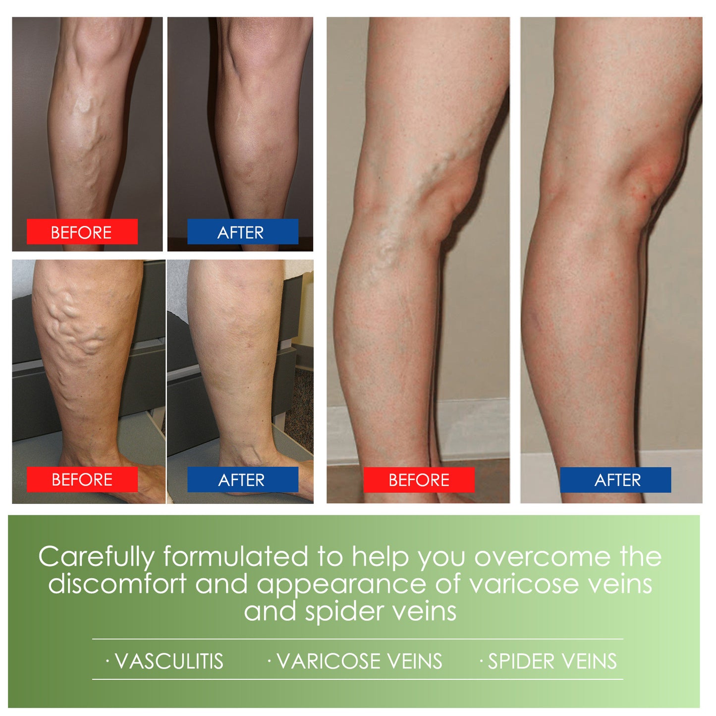 Varicose Vein Cream