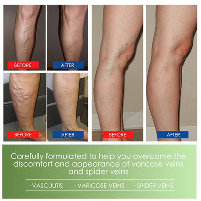 Varicose Vein Cream