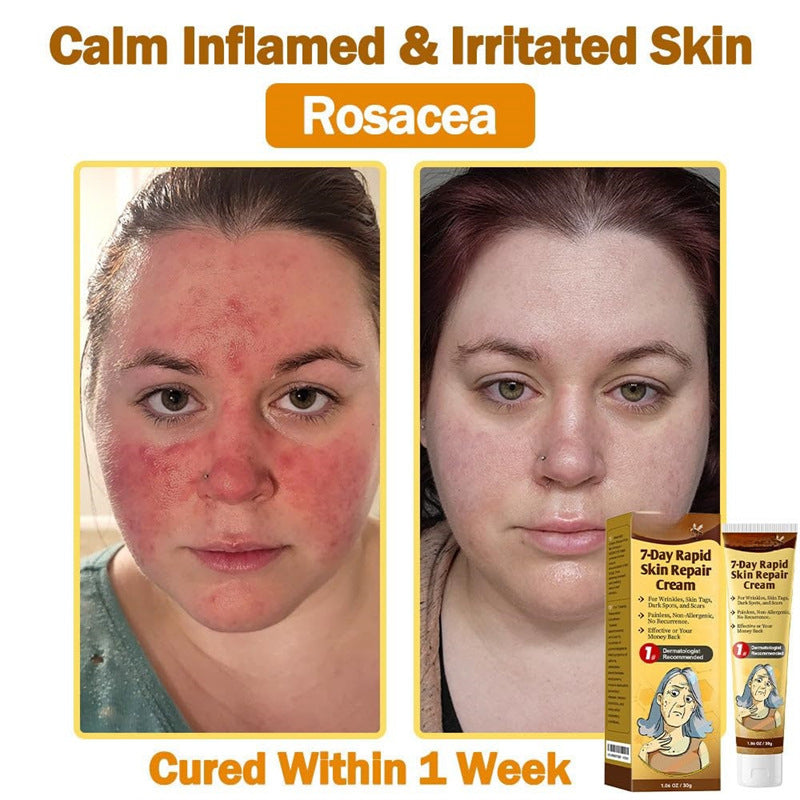 Acne Scar Repair Cream