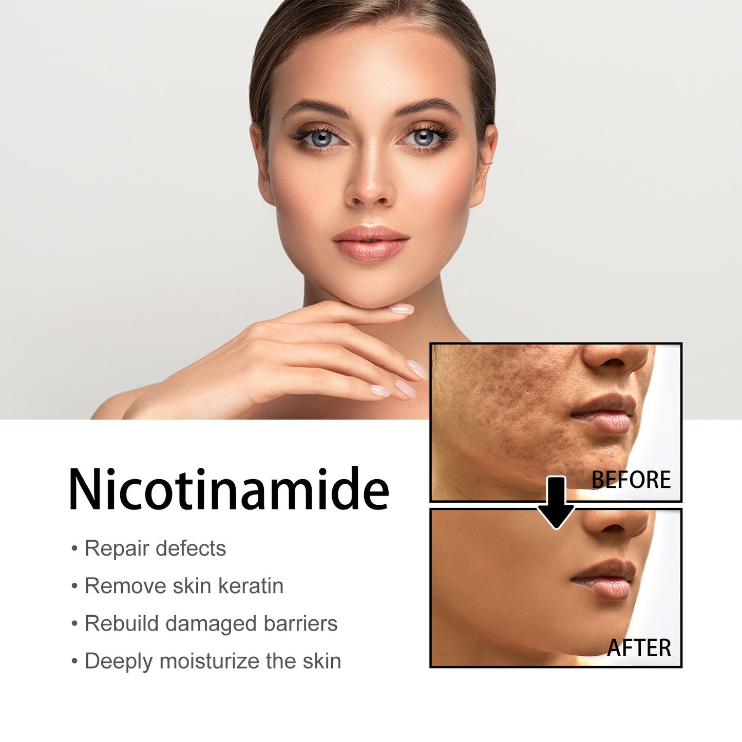 Acne Whitening Serum