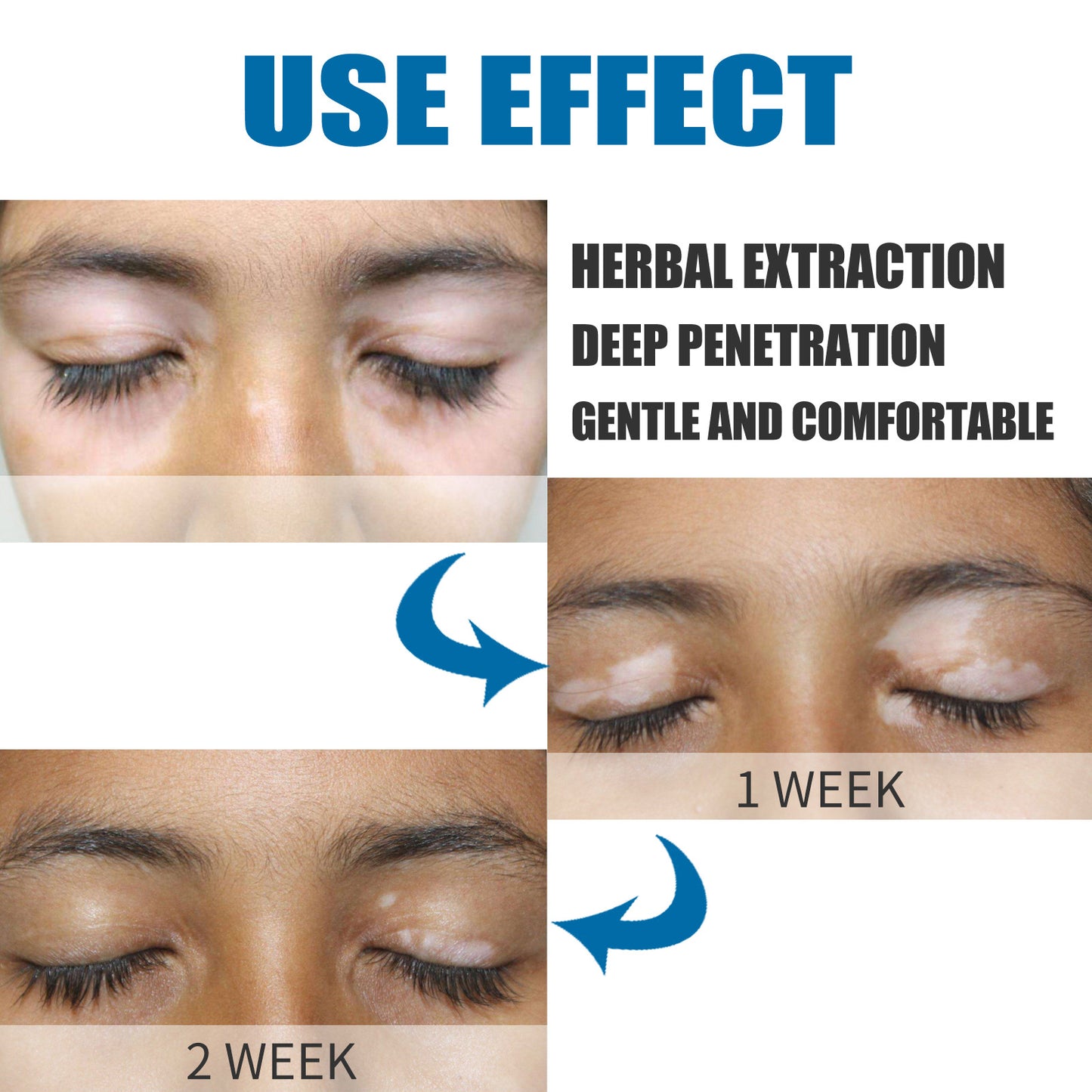 South Moon Vitiligo Treatment