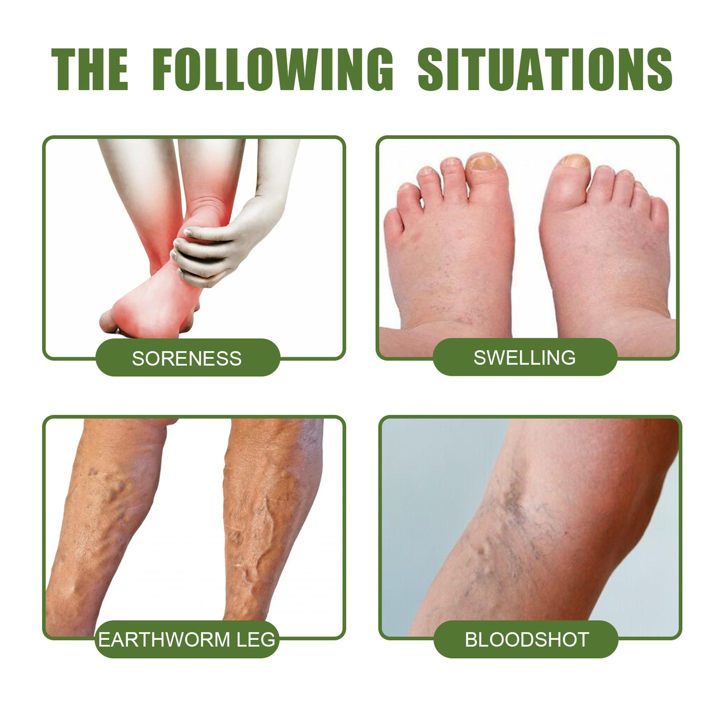 Varicose Vein Cream