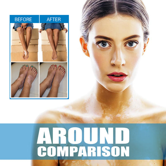 South Moon Vitiligo Treatment
